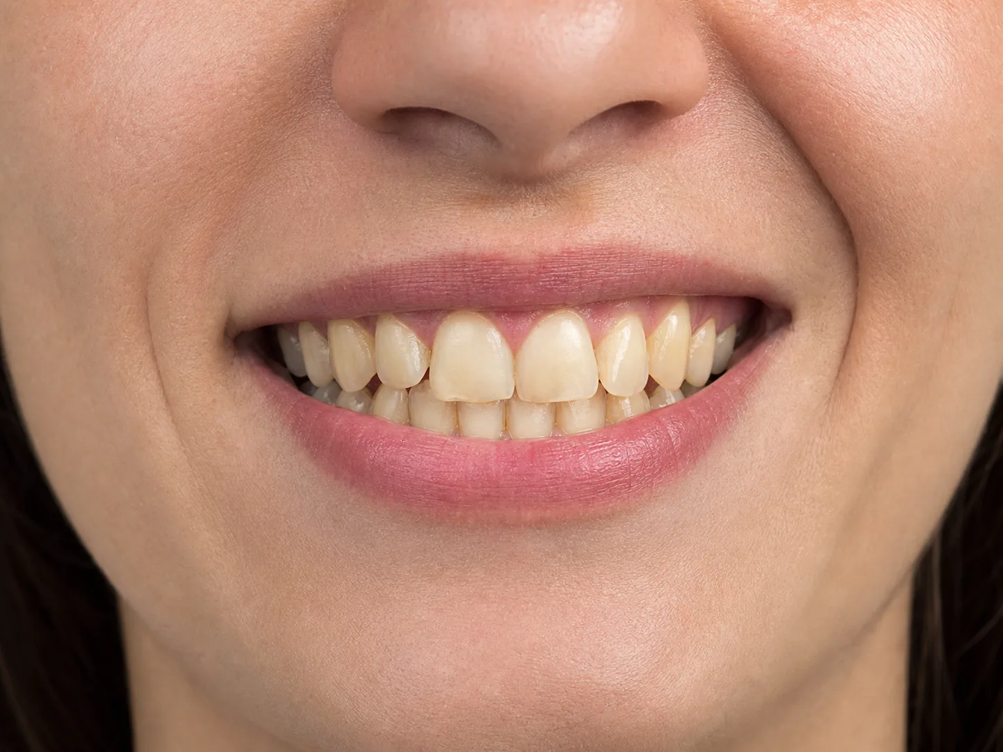 Sonrisa antes de un tratamiento dental estético